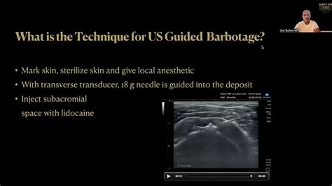 How To Treat Calcific Rotator Cuff Tendinopathy Ultrasound Guided Barbotage And Prp Injection