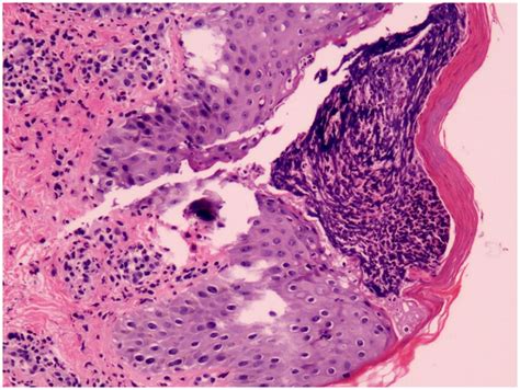 Histologic Examination Shows Acanthosis Mild Spongiosis And