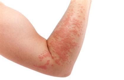 Different Skin Allergies Causes And Treatments Life