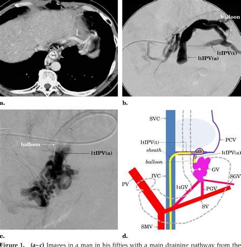 Figure 1 From Can Balloon Occluded Retrograde Transvenous Obliteration