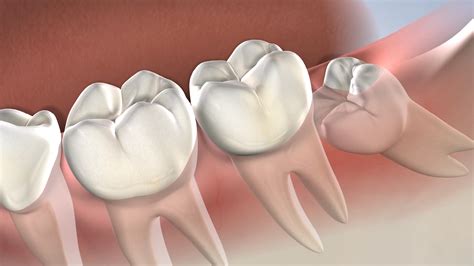 Wisdom Tooth Extraction Growing Improperly