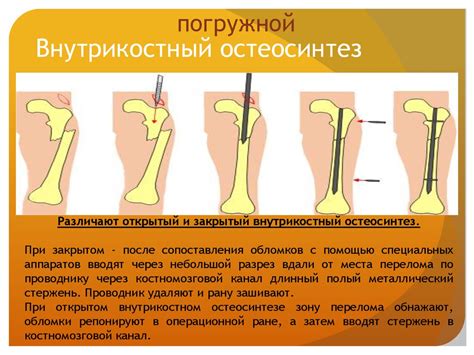 Виды остеосинтеза - презентация онлайн