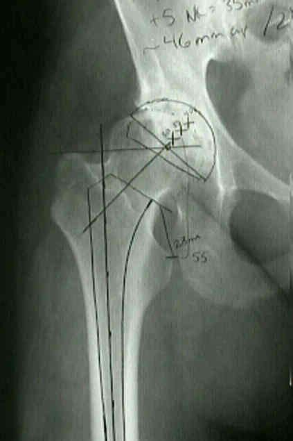 Preop Acetabular Radiographic Evaluation Wheeless Textbook Of Orthopaedics