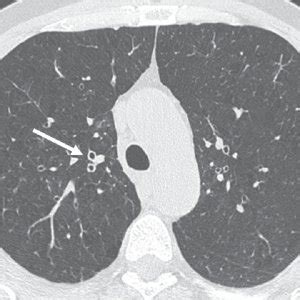 Thin Section CT Scan Of A Smoker With Chronic Cough Associated With