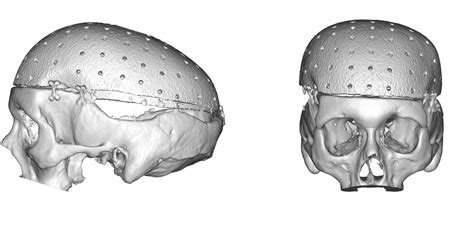 Plastic Surgery Case Study Total Skull Implant With Onlay Bone Cement