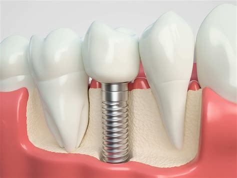 Understanding Dental Bone Graft: Process, Healing & What It Is | 360 ...