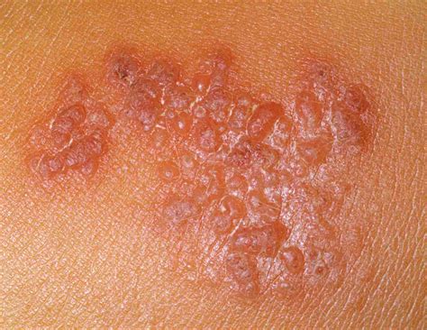 20 Types Of Skin Lesions Causes And Pictures