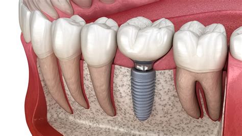 Todo Lo Que Tienes Que Saber Sobre Los Implantes Dentales Para