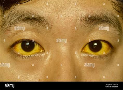 Carrots Jaundice At Steven Waddy Blog
