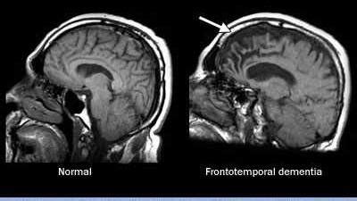 brain scan frontal lobe dementia imaging   living brain