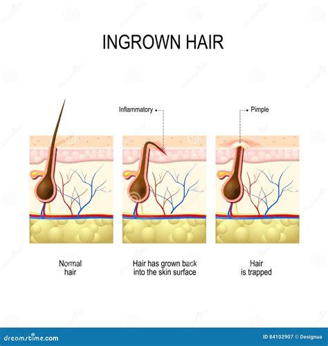 ingrown cheek hair 1