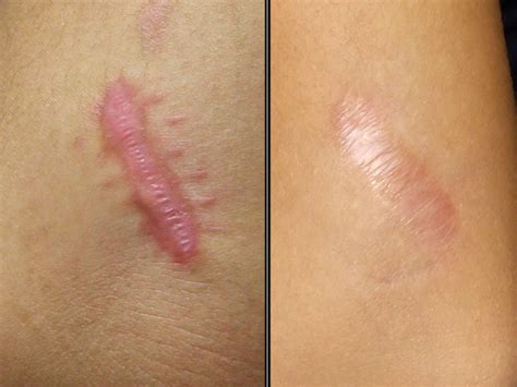 Keloid Scar Treatment By Vascular Laser Intralesional Keloid