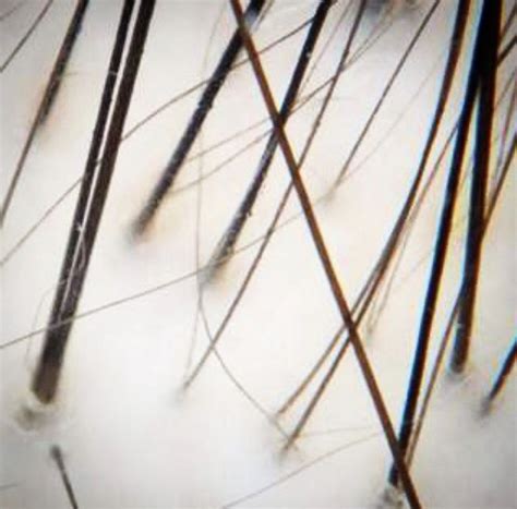 trichoscopy  androgenetic alopecia donovan hair clinic