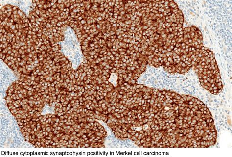 Pathology Outlines Merkel Cell Carcinoma