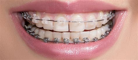 Керамические брекеты - установка брекет-систем в СПб по доступной цене