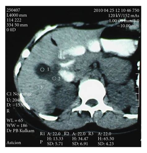 Ct Scan Of Liver Hydatid Cysts Download Scientific Diagram