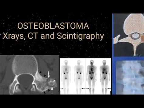 Osteoblastoma Radiology x ray. CT and Scintigraphy - YouTube