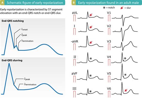 Early Repolarization On Ecg When Guidelines Confuse Ecg Criteria Ecg Learning