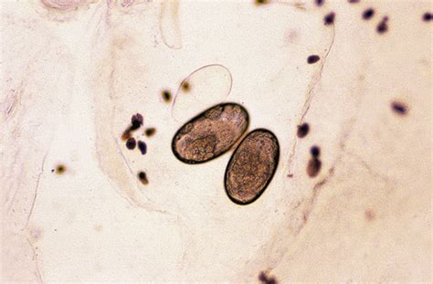 Scabies (Human Itch Mite) | Anesthesia Key