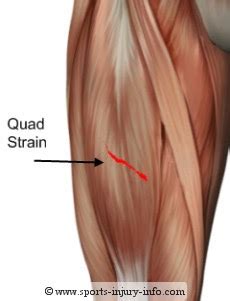 manda manda mandaaa.: Grade 3 Muscle Strain