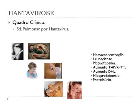 A Hantavirose É Uma Febre - PPT - Hantaviroses PowerPoint Presentation, free download - ID:4099664