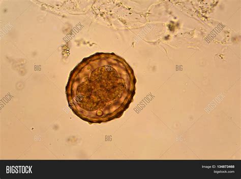 Ascaris Ova In Stool