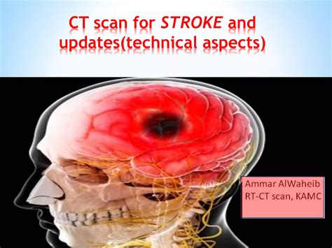 CT scan of the brain in stroke patients | PPTX