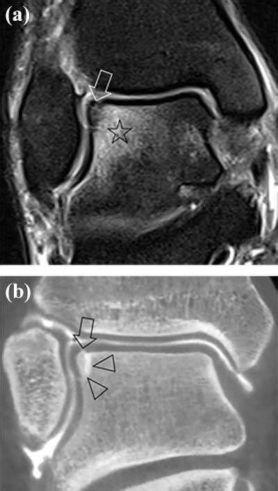 Staging Of Osteochondral Lesions Of The Talus Mri And Cone Beam Ct