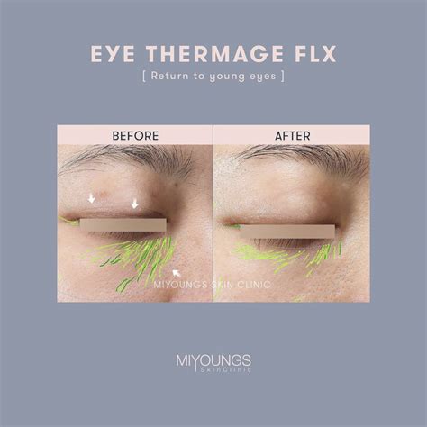 Eye Thermage | MIYOUNGS