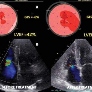 Transthoracic Echocardiographic Images For Right Ventricle Before And