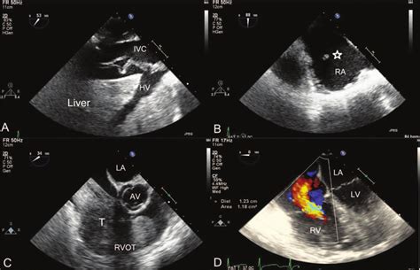 Intraoperative Transesophageal Echocardiography Examination Before