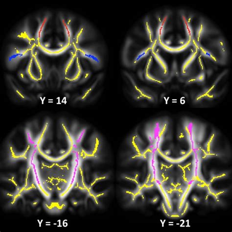 Coronal Views Of The Regions Of Interest In The White Matter Underlying