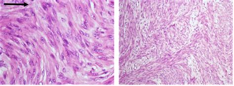 Histology Micrograph Of The Parasitic Fibroid Nodules Showing Whorled