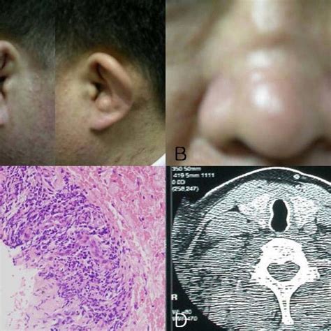 (A) Photographs of both external ears show auricular cartilage ...