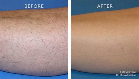 Laser Hair Removal Before And After