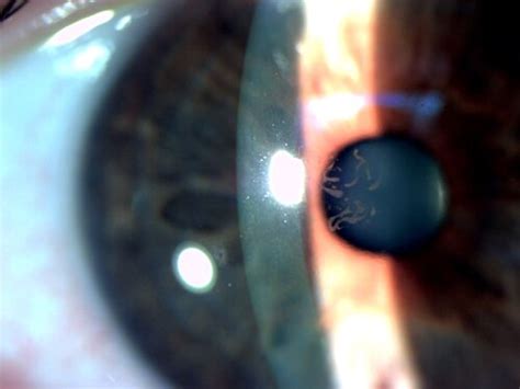 Map Dot Fingerprint Dystrophy — Moyes Eye Center