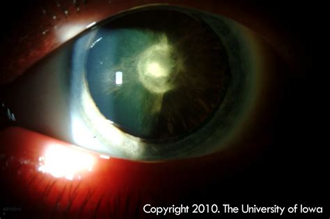 Posterior Subcapsular Cataract