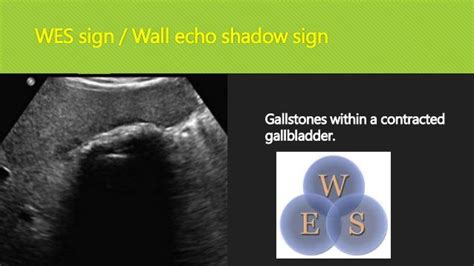 Wes Sign Wall Echo Shadow Sign Gallstones Within A Contracted