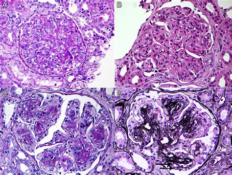 Etiology Based Diagnostic Approach To Proliferative Glomerulonephritis American Journal Of