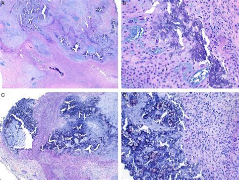 Histologic Images From Case 14 H E Sections Demonstrate Nodular