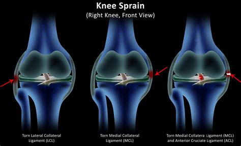 Knee Buckling What Can Cause Knees To Buckle