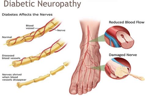 New Life Neuropathy Presentation On Peripheral Neuropathy Artofit