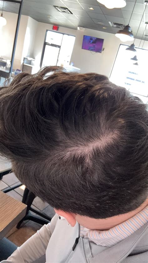 Telogen Effluvium or is this what happens with regular pattern baldness
