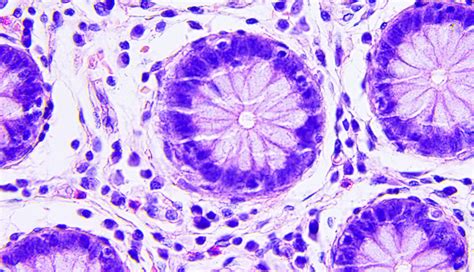 comparative malignancy risks    general population rheumatology