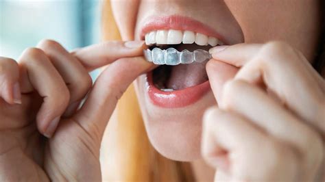 4 Invisalign Aftercare Tips To Know For A Perfect Smile