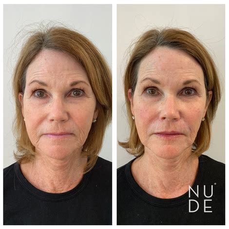 Before After Gallery Nude Medical Aesthetics