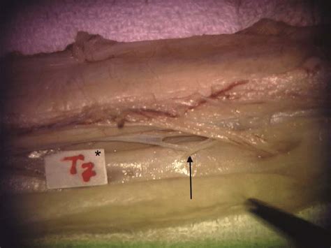 Microphotograph demonstrating a "Y" shaped denticulate ligament (arrow ...