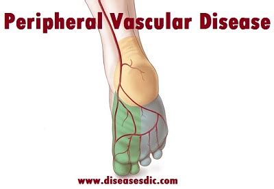 Peripheral Vascular Disease (PVD)- Causes, Treatment and Prevention