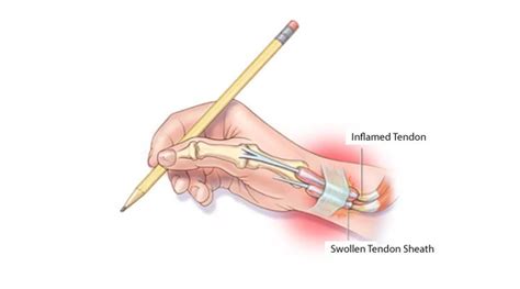 De Quervains Tenosynovitis Men S Health Clinic At Dtap Singapore