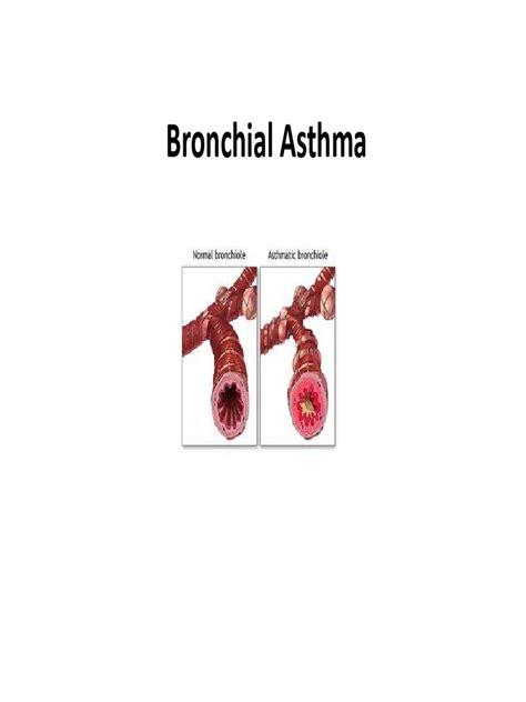 Bronchial Asthma | PDF
